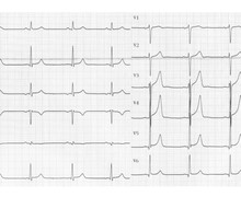 Orthodromic tachycardia due to an accessory pathway (AVRT)