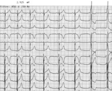 Intermittent pattern of ventricular pre-excitation