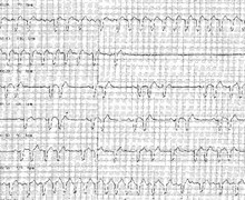 Atrial flutter and post-tachycardia syncope