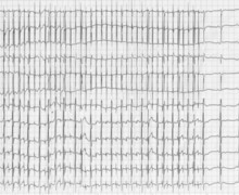 Atrial flutter in a newborn with transposition of great vessels