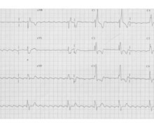 Common flutter in a patient with congenital heart disease