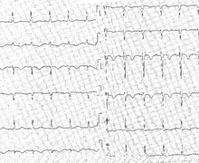Severe pulmonary embolism and evolution of tracings