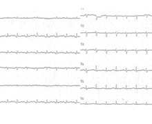 Pericardial effusion with decreased ventricular voltages
