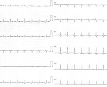 Pericardial effusion with decreased ventricular voltages