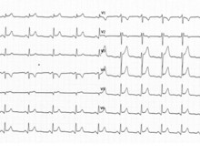 Electrocardiographic evolution during acute pericarditis