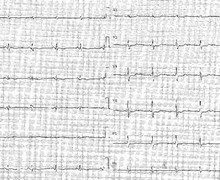 NSTEMI and unstable angina 