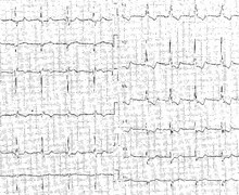 NSTEMI and unstable angina 