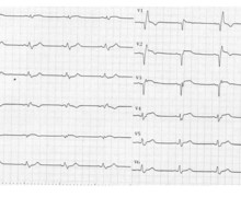 Anterior infarction and right bundle branch block appearance