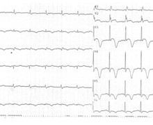 Anterior infarction in a patient with a prior right bundle branch block