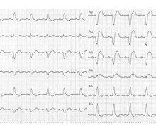 Acute anterior myocardial infarction and appearance of a left bundle branch block