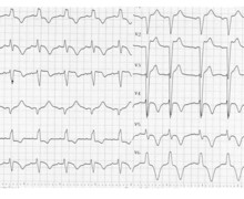Anterior infarction in a patient with a pre-existing left bundle branch block