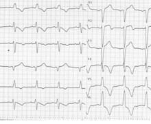 Anterior infarction in a patient with a pre-existing left bundle branch block