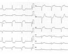 Inferior infarction with right ventricular extension