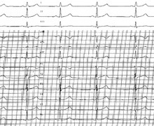 Etalonnage, calibration et calcul de la fréquence cardiaque