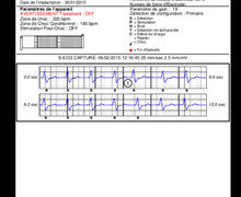 Défibrillateur sous-cutané, stimulateur cardiaque et épreuve d'effort