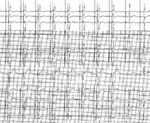 Reduction of percentage ventricular pacing with MVP 