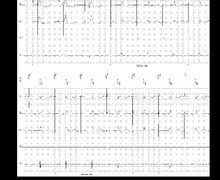 Vp suppression algorithm and decrease in unnecessary right ventricular pacing