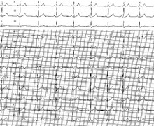 Etalonnage, calibration et calcul de la fréquence cardiaque - NEW