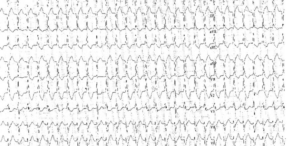 Tachycardie ventriculaire, complexes de capture et de fusion (ECN)