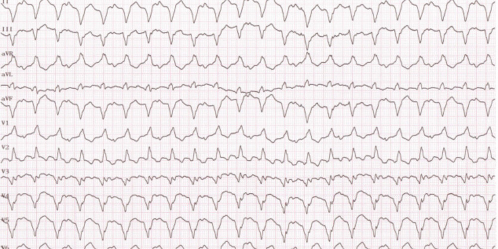 Activité atriale et tachycardie ventriculaire (ECN)