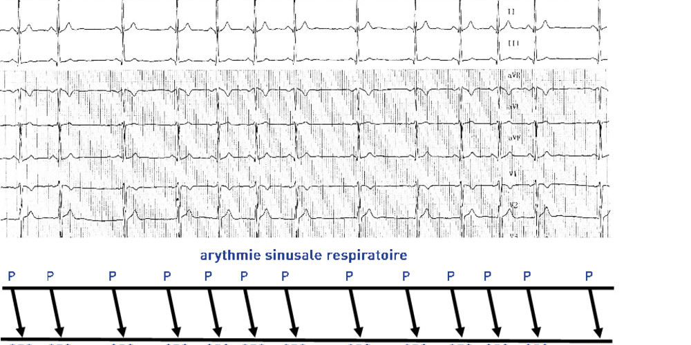 Arythmie sinusale respiratoire (ECN)