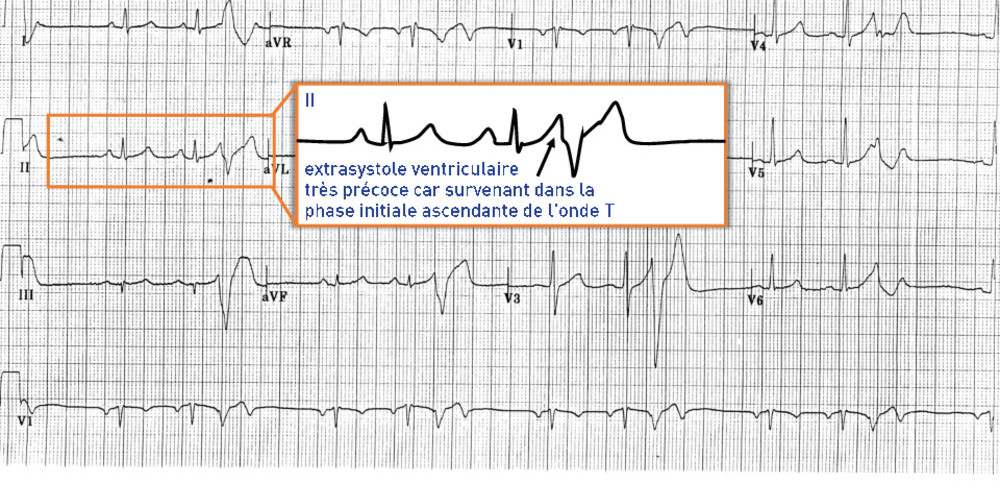 Extrasystoles ventriculaires très précoces et risque de fibrillation ventriculaire (ECN)