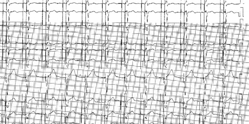 Stimulateur cardiaque (ECN)