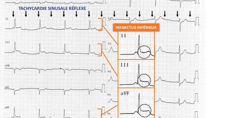 BAV III et infarctus inférieur (ECN)