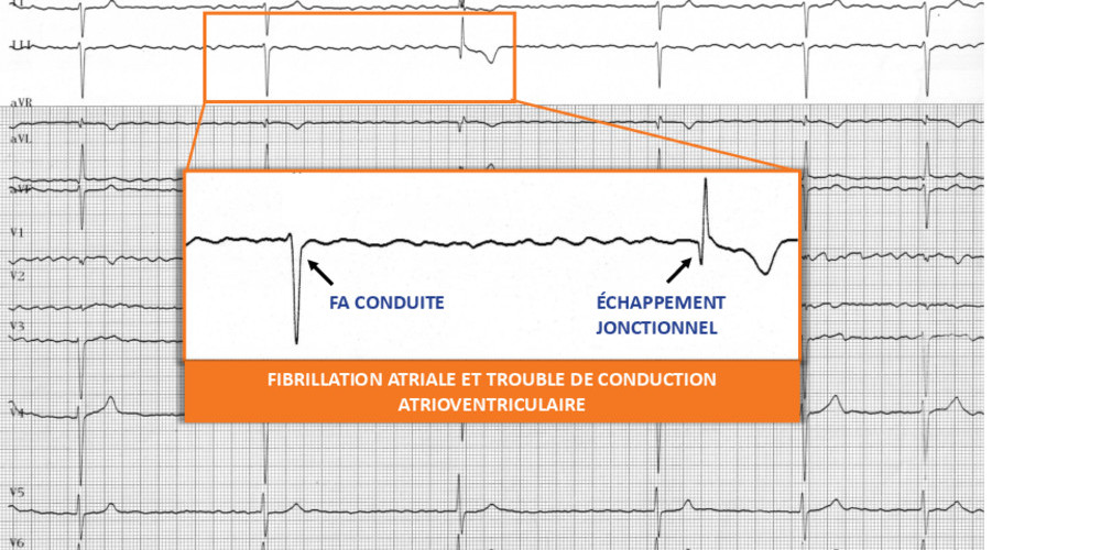 Fibrillation atriale et trouble de conduction atrio-ventriculaire (ECN)