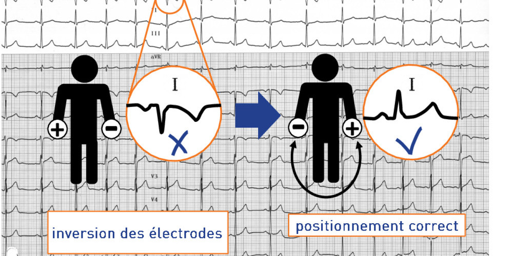 Erreurs de positionnement des électrodes (ECN)
