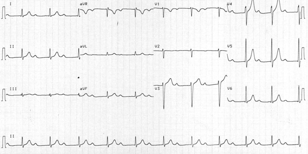 First-degree atrioventricular block and very long PR