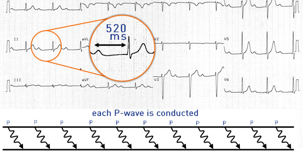 First-degree atrioventricular block and very long PR
