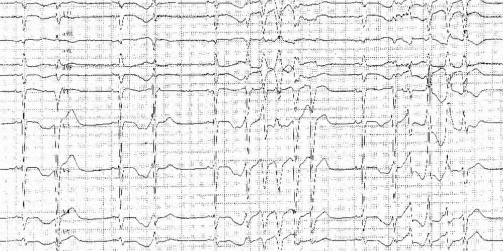 Tachycardie polymorphe et allongement majeur de l'intervalle QT
