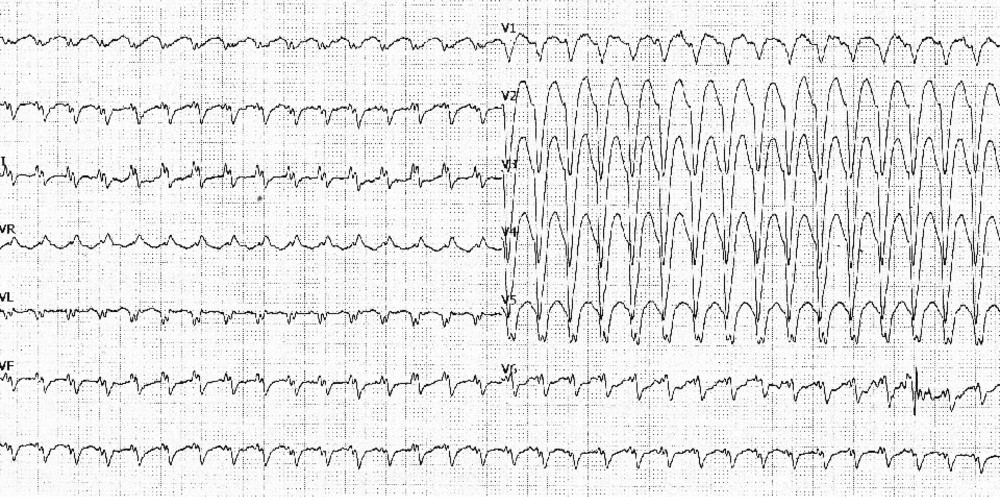 Analyse de l'aspect du QRS et diagnostic de tachycardie ventriculaire