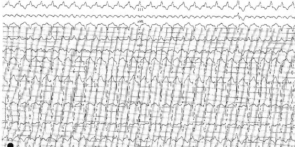 Tachycardie ventriculaire sur dysplasie arythmogène du ventricule droit