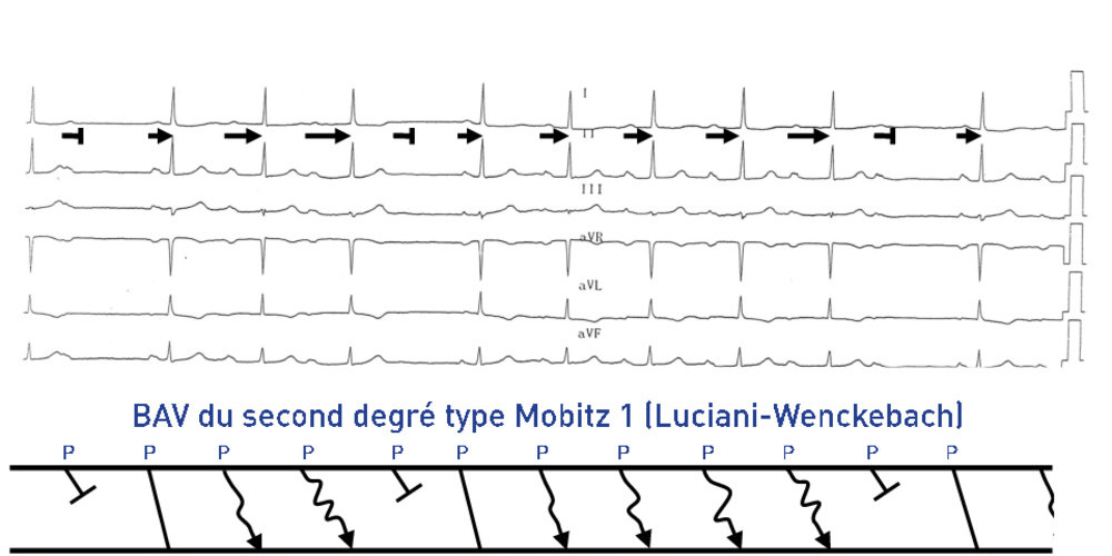 Bloc auriculo-ventriculaire du second degré type Luciani-Wenckebach 