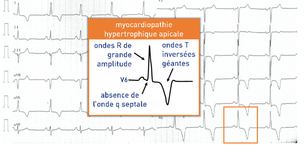 Myocardiopathie hypertrophique apicale 