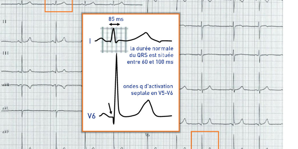 Activation ventriculaire normale et durée du complexe QRS