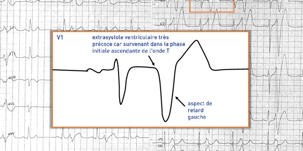 ESV très précoce et risque de fibrillation ventriculaire 2