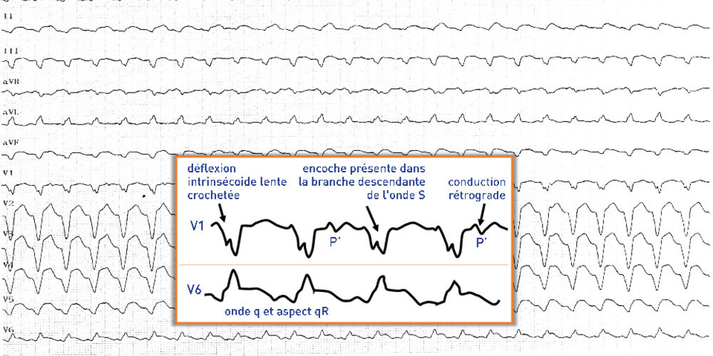 Analyse de l'aspect du QRS et diagnostic de tachycardie ventriculaire